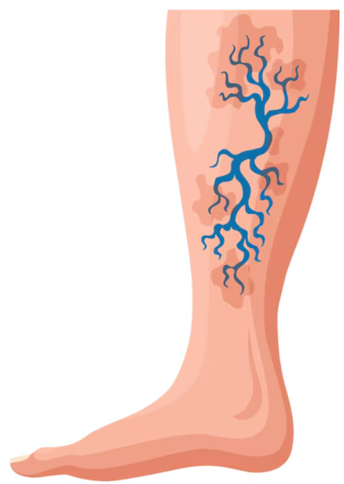 하지정맥류 발생 구조 – 정맥 판막 손상과 혈류 역류 시각화