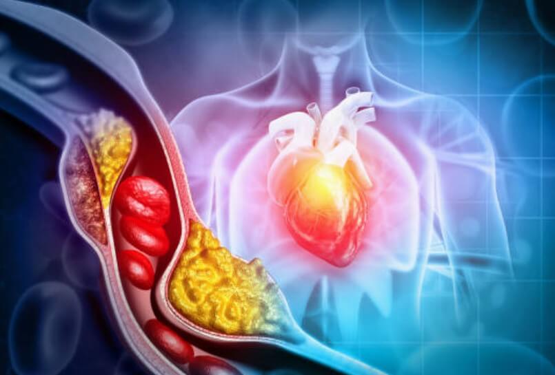 고지혈증약 부작용