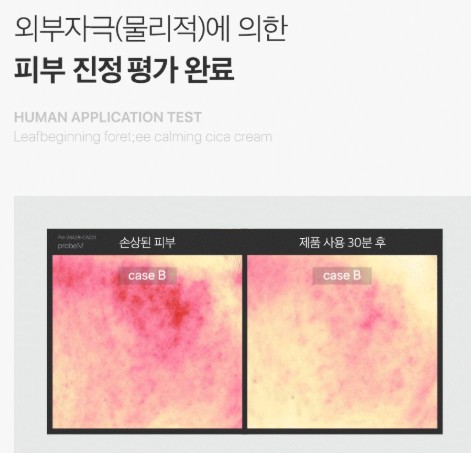 포레티-시카-크림으로-손상된-피부가-진정되는-이미지를-배교해서-보여주고-있습니다.