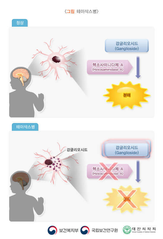 테이삭스병 신경세포와 리소좀 효소 결핍