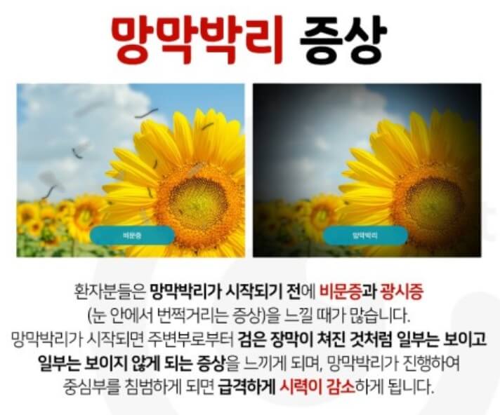 망막박리