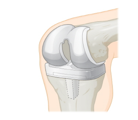 무릎 인공관절 치환술 수술과정 및 주의사항