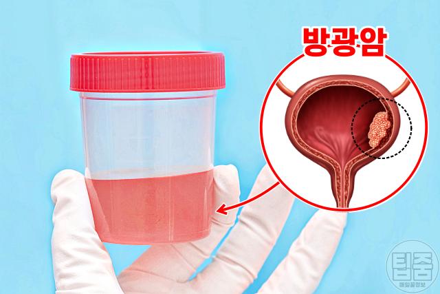 방광암 증상 통증 없는 혈뇨