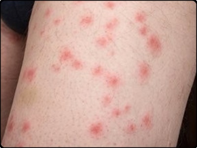 빈대 물린자국 증상