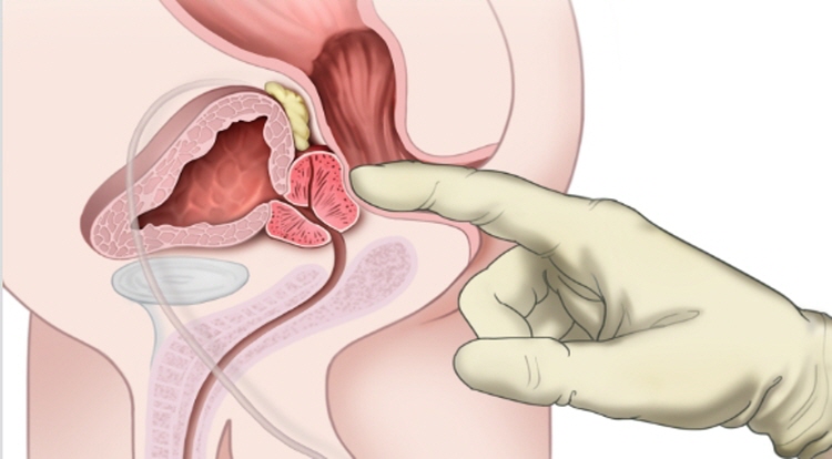 전립선염 증상