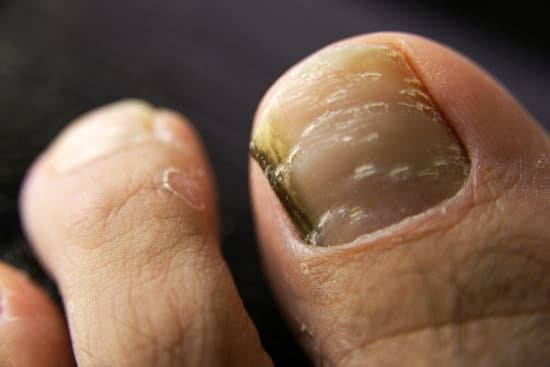 발톱 성장판 제거술 (Matricectomy, 영구 발톱 제거) &ndash; 수술 방법 &amp; 회복 과정