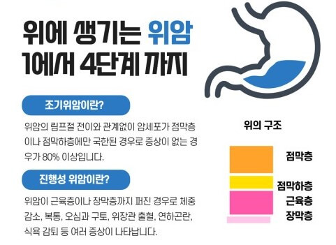 위암의 진행경과
