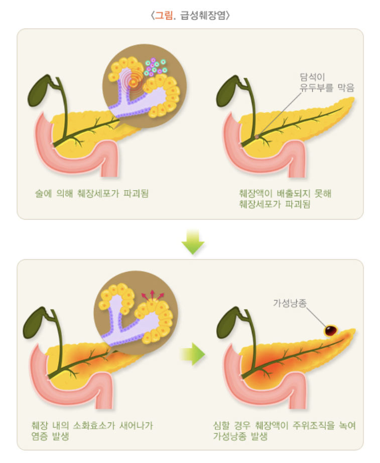 급성췌장염
