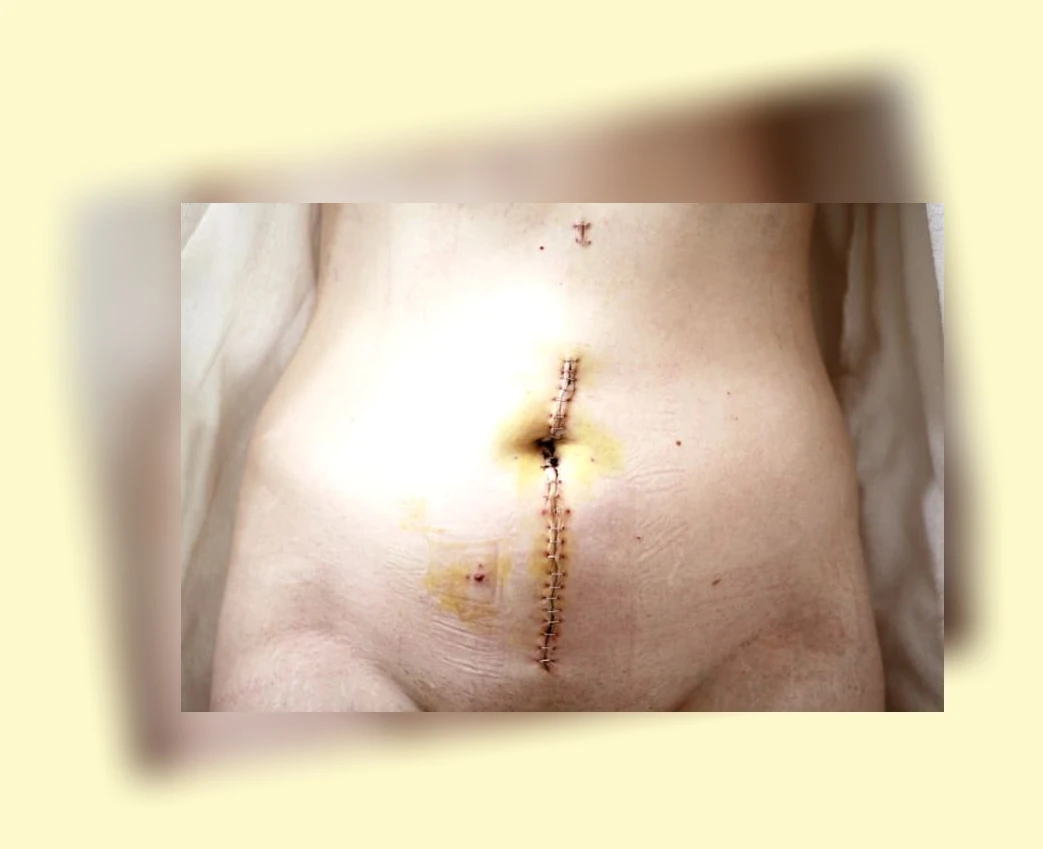 폐렴 회복_2_subsection