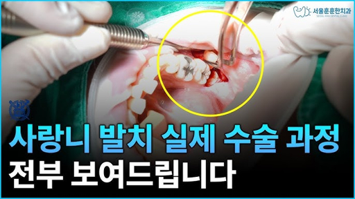 사랑니 발치 후 식사 가이드