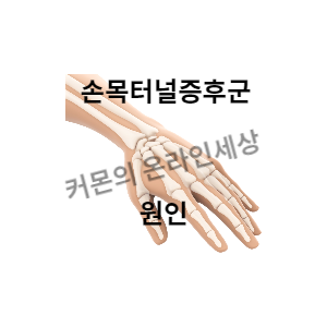 손목터널증후군