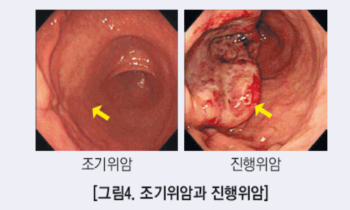 위암 이미지