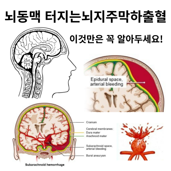 지주막하-출혈-증상