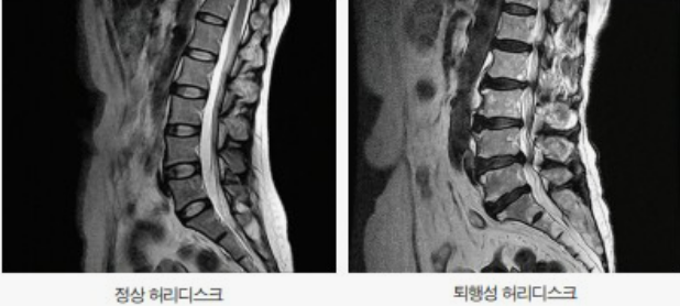 허리디스크 사진