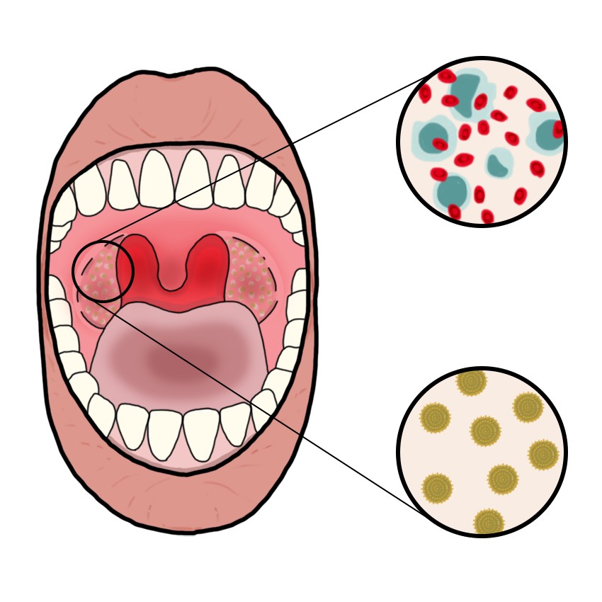 감염성 단핵구증(Infectious mononucleosis)