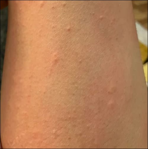 두드러기가 생긴 팔