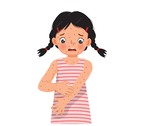 수두_원인_증상_치료방법