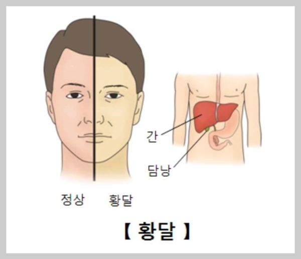 황달