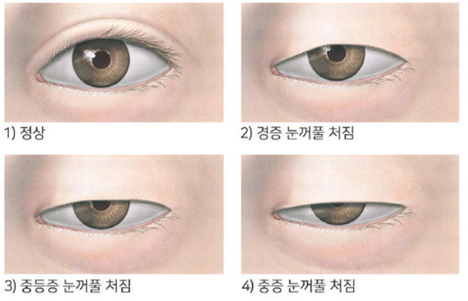 눈 성형 수술