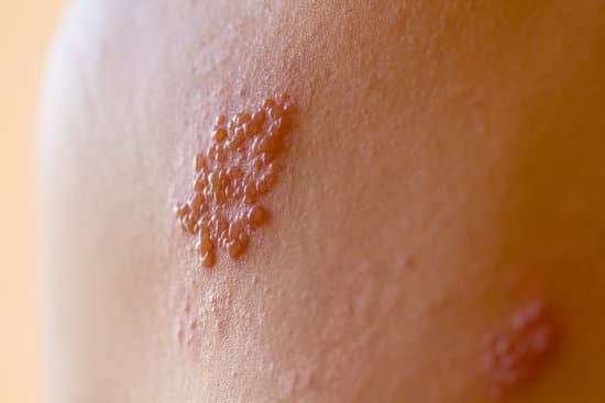 대상포진 (Herpes Zoster): 원인, 증상, 치료 및 예방