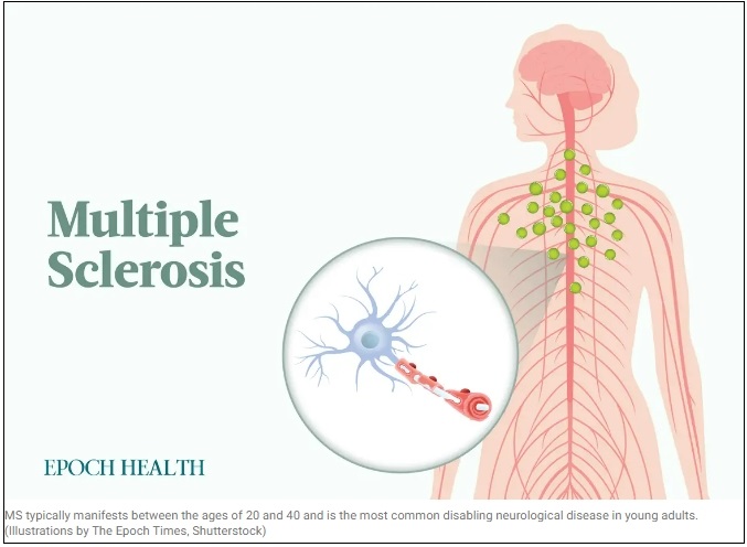 다발성 경화증(MS): 증상, 원인 및 치료 The Essential Guide to Multiple Sclerosis: Symptoms, Causes, Treatments, and Natural Approaches