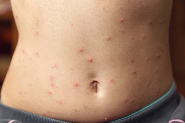 신체 부위별 대상포진 발병 상황