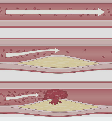 고지혈증에 좋은 음식 나쁜 음식 관리방법 파헤치기