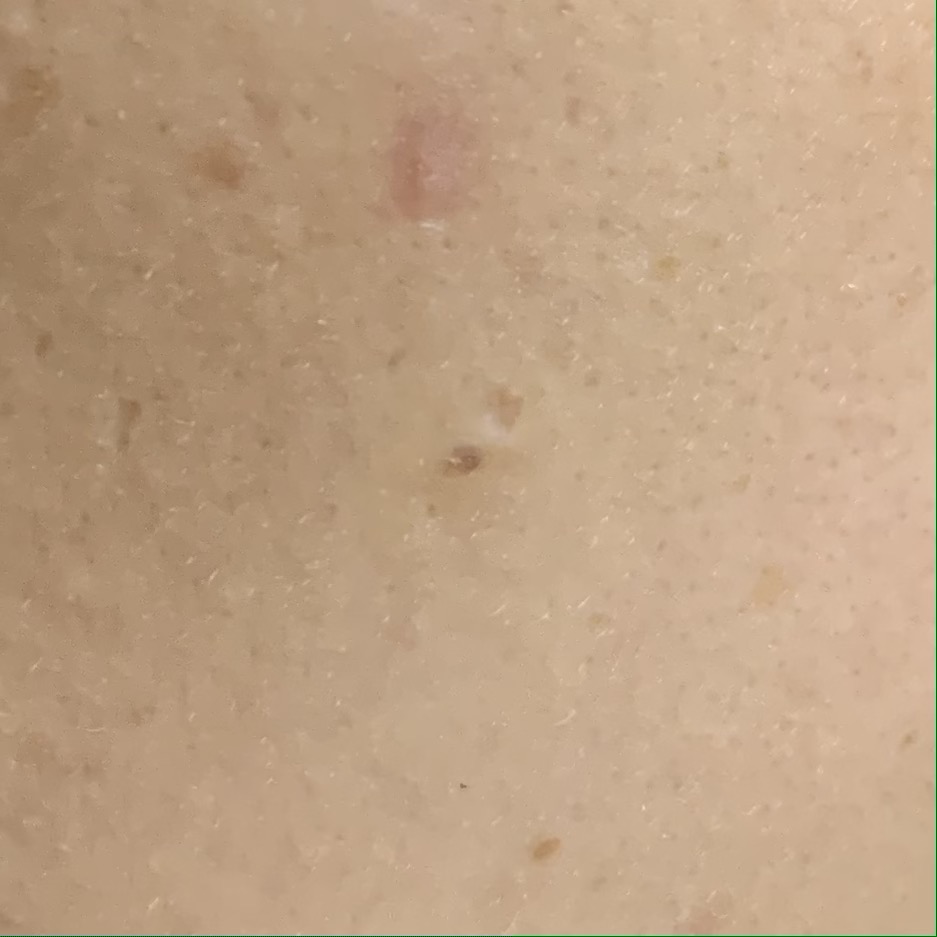 피지낭종 수술후기