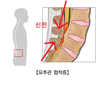 요추관 협착증