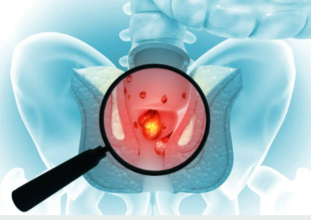 치질원인 치료방법