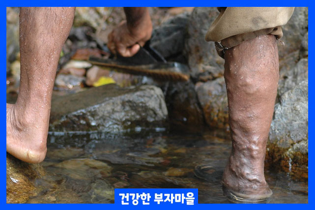 하지정맥류 증상 9가지