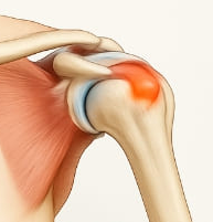 어깨 석회질 치료방법