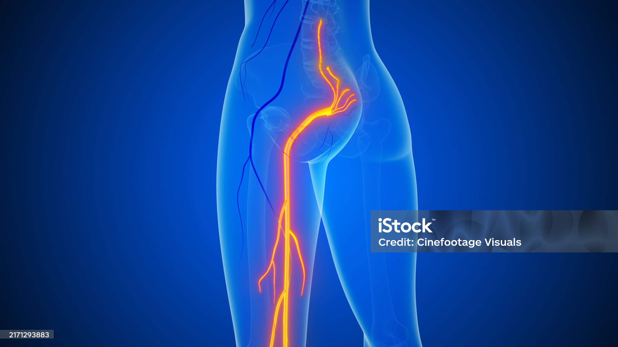 좌골신경통-관련-사진