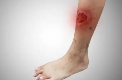 백혈병 초기증상 12