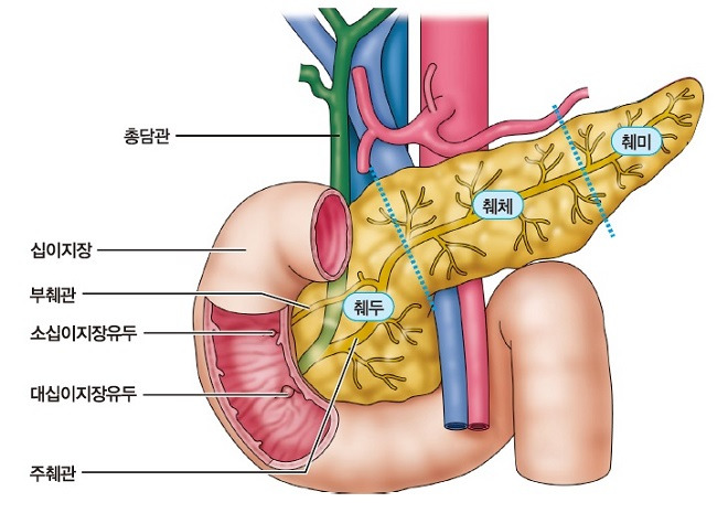 췌장암 초기증상