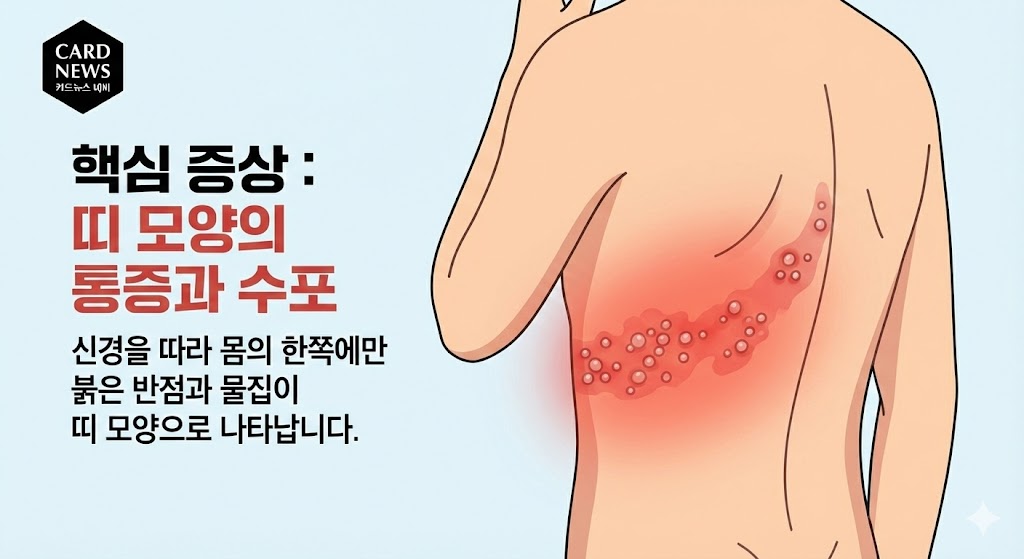 대상포진