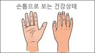 손톱으로 보는 건강상태