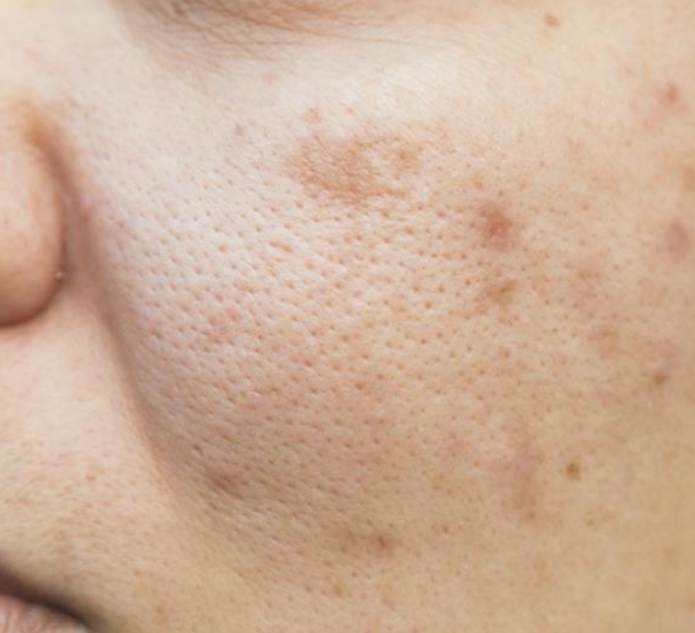 멜라토닝크림 효과