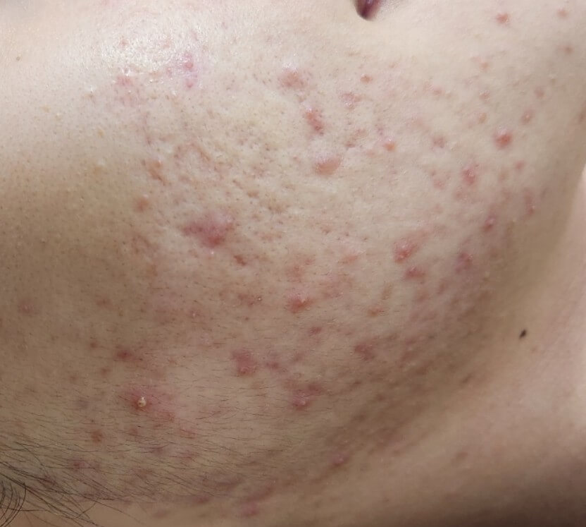 화농성 여드름 증상