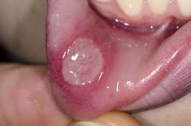 입안 염증이 생기는 이유