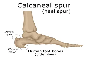 발바닥-통증부위