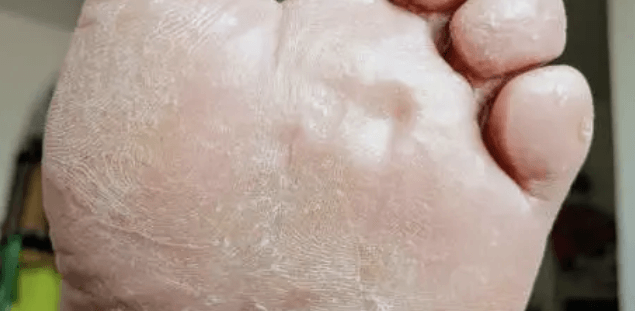 여름철 무좀 원인, 무좀 증상, 무좀 약 치료 방법 총정리