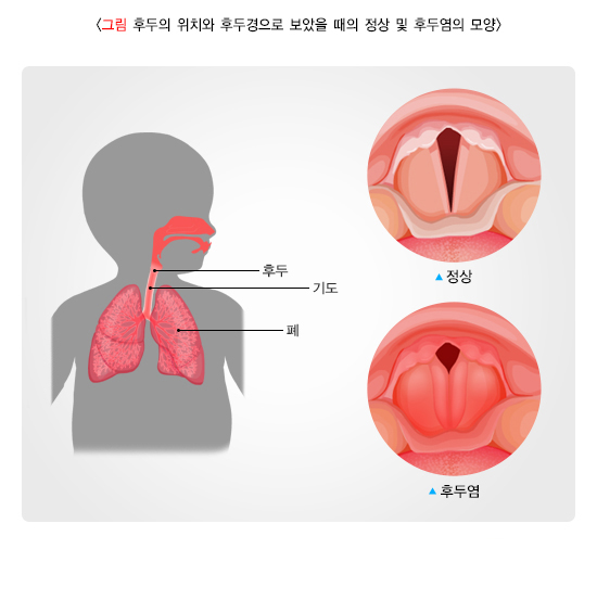 후두염 증상 나타내는 사진