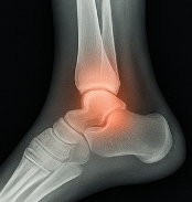 발목 접질렀을때