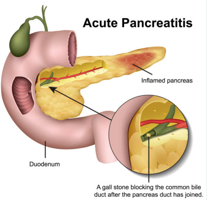 급성 췌장염과 관련된 사진2