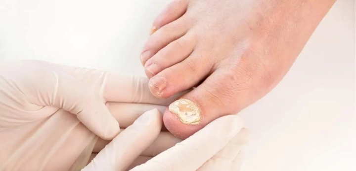 손발톱-곰팡이-감염