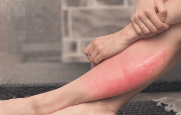 봉와직염의 증상