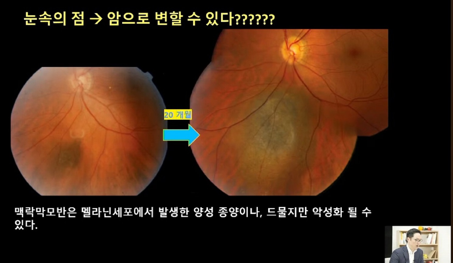안구종양-안과-김민-교수