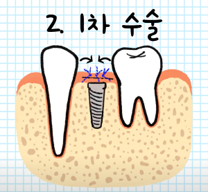 1차 수술