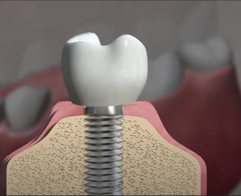 임플란트 주위염 ; 증상&amp;#44; 원인&amp;#44; 예방 및 관리방법 알아보기(재수술&amp;#44; 부작용&amp;#44; 재식립)